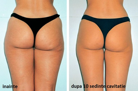 cavitatie3