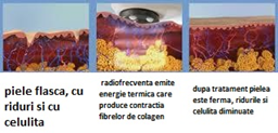 radiofrecventa